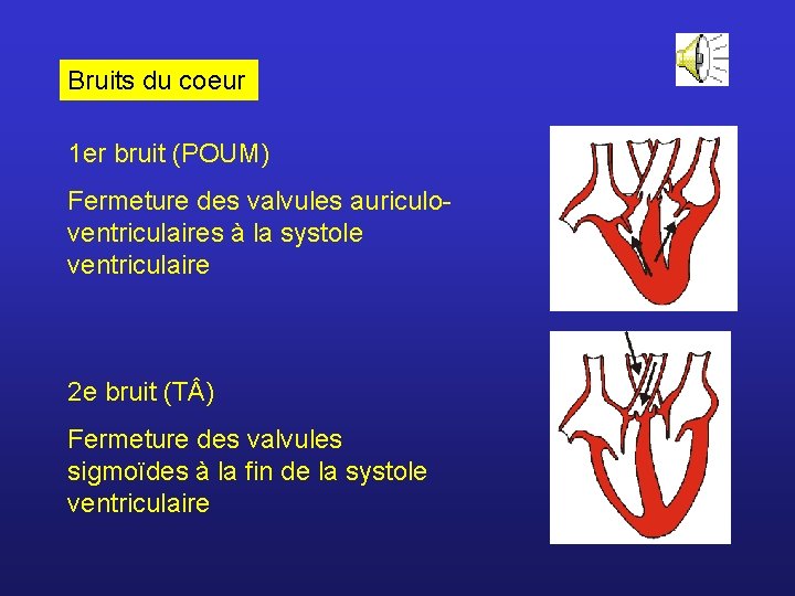 Bruits du coeur 1 er bruit (POUM) Fermeture des valvules auriculoventriculaires à la systole