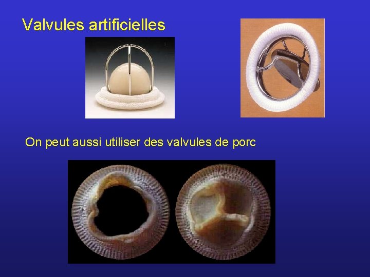 Valvules artificielles On peut aussi utiliser des valvules de porc 