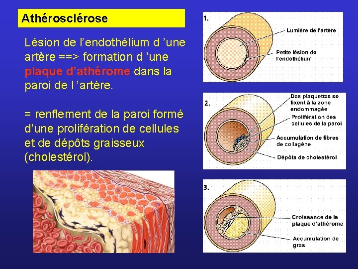 Athérosclérose Lésion de l’endothélium d ’une artère ==> formation d ’une plaque d’athérome dans