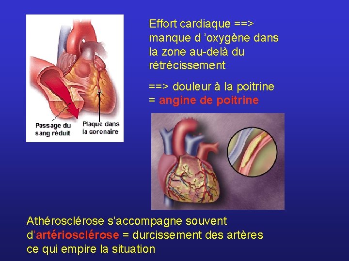 Effort cardiaque ==> manque d ’oxygène dans la zone au-delà du rétrécissement ==> douleur