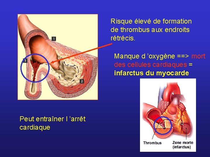 Risque élevé de formation de thrombus aux endroits rétrécis. Manque d ’oxygène ==> mort