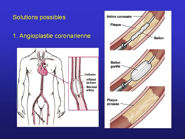 Solutions possibles 1. Angioplastie coronarienne 