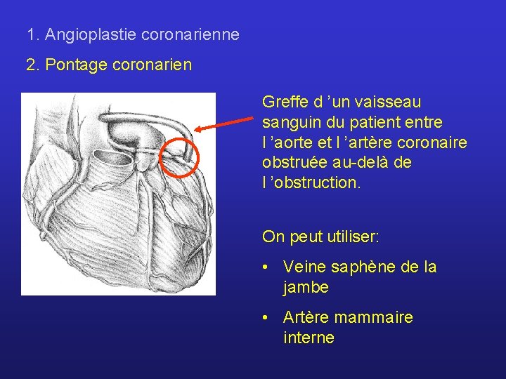 1. Angioplastie coronarienne 2. Pontage coronarien Greffe d ’un vaisseau sanguin du patient entre