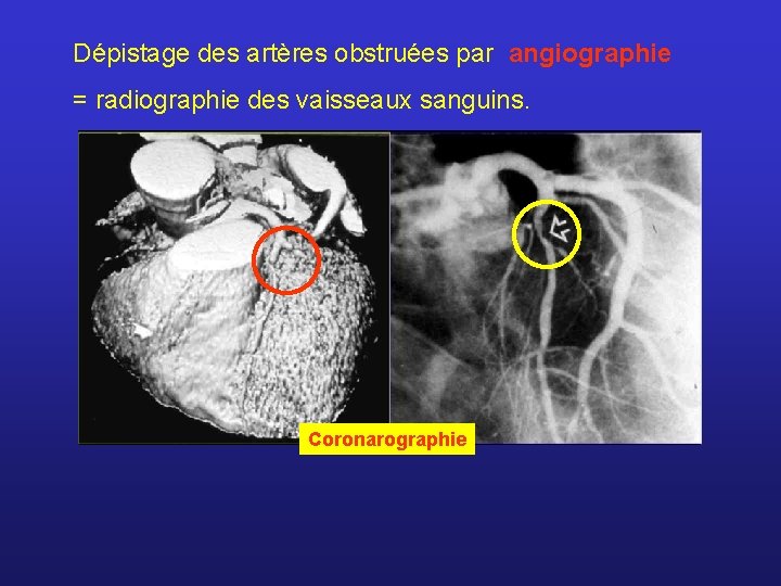 Dépistage des artères obstruées par angiographie = radiographie des vaisseaux sanguins. Coronarographie 