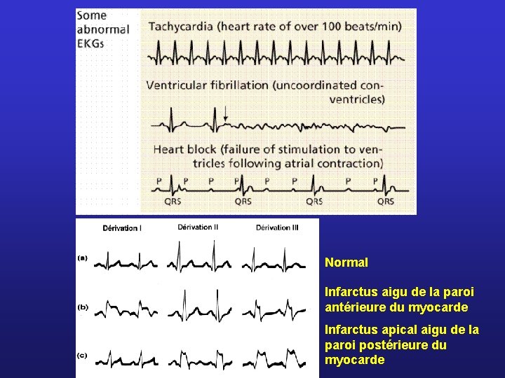 Normal Infarctus aigu de la paroi antérieure du myocarde Infarctus apical aigu de la