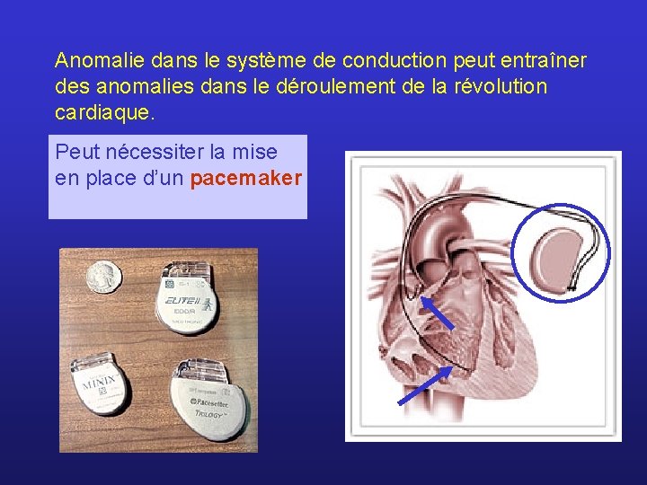 Anomalie dans le système de conduction peut entraîner des anomalies dans le déroulement de