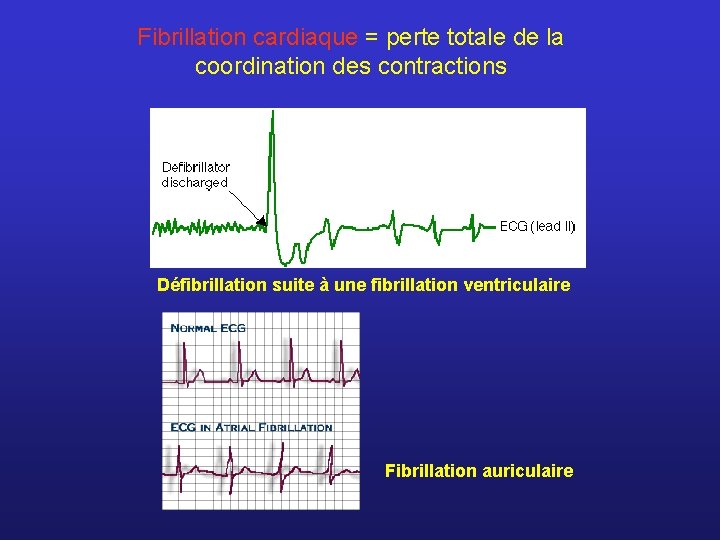 Fibrillation cardiaque = perte totale de la coordination des contractions Défibrillation suite à une