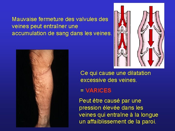 Mauvaise fermeture des valvules des veines peut entraîner une accumulation de sang dans les