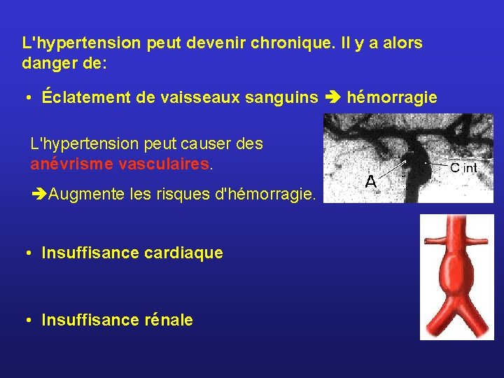 L'hypertension peut devenir chronique. Il y a alors danger de: • Éclatement de vaisseaux