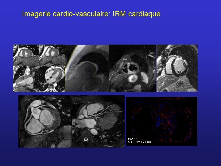 Imagerie cardio-vasculaire: IRM cardiaque 