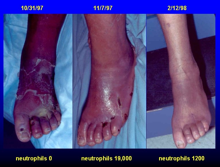 10/31/97 neutrophils 0 11/7/97 neutrophils 19, 000 2/12/98 neutrophils 1200 