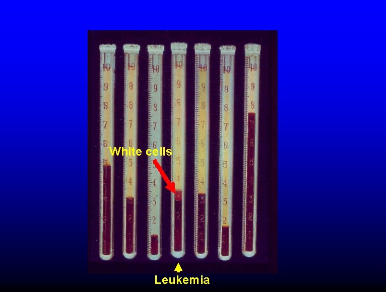 White cells Leukemia 