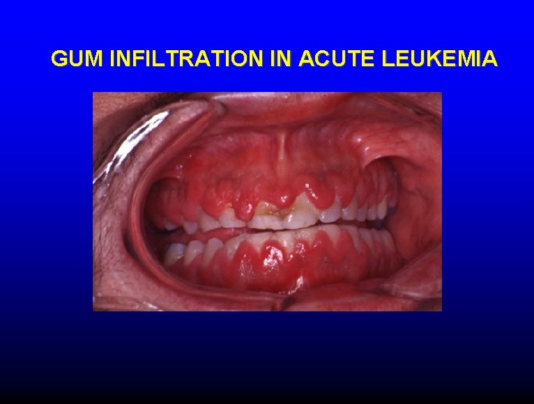 GUM INFILTRATION IN ACUTE LEUKEMIA 
