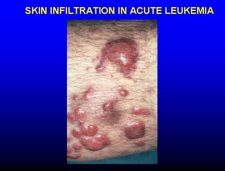 SKIN INFILTRATION IN ACUTE LEUKEMIA 