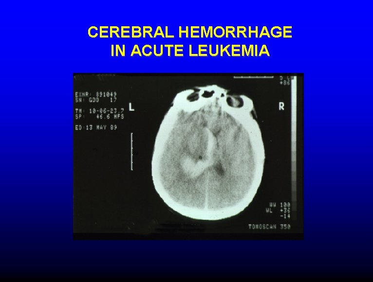 CEREBRAL HEMORRHAGE IN ACUTE LEUKEMIA 