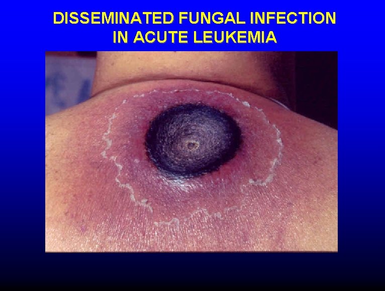 DISSEMINATED FUNGAL INFECTION IN ACUTE LEUKEMIA 