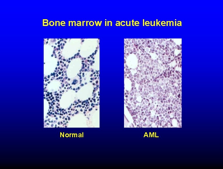 Bone marrow in acute leukemia Normal AML 