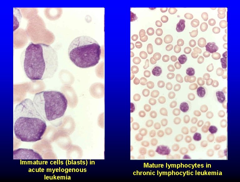 Immature cells (blasts) in acute myelogenous leukemia Mature lymphocytes in chronic lymphocytic leukemia 