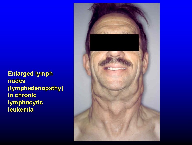 Enlarged lymph nodes (lymphadenopathy) in chronic lymphocytic leukemia 