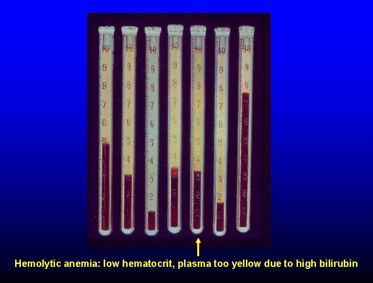 Hemolytic anemia: low hematocrit, plasma too yellow due to high bilirubin 