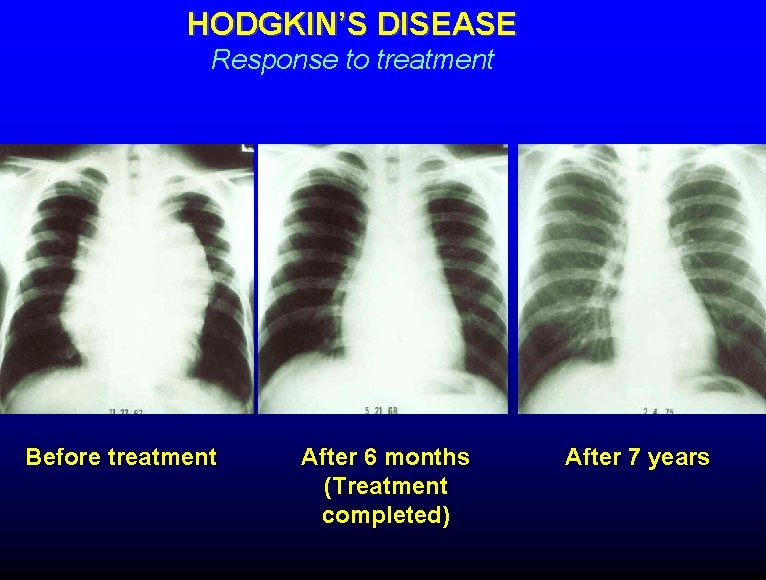 HODGKIN’S DISEASE Response to treatment Before treatment After 6 months (Treatment completed) After 7
