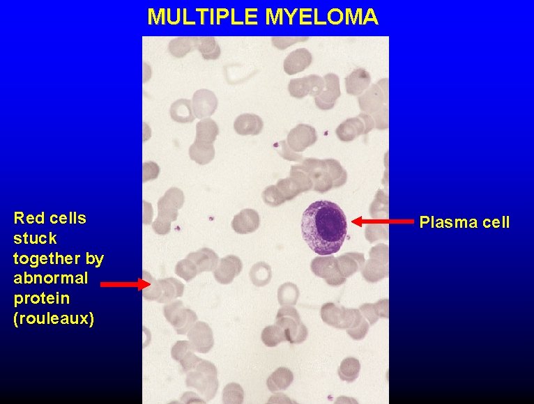MULTIPLE MYELOMA Red cells stuck together by abnormal protein (rouleaux) Plasma cell 