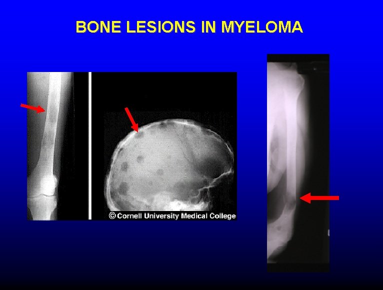 BONE LESIONS IN MYELOMA 