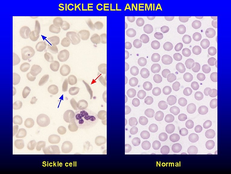 SICKLE CELL ANEMIA Sickle cell Normal 