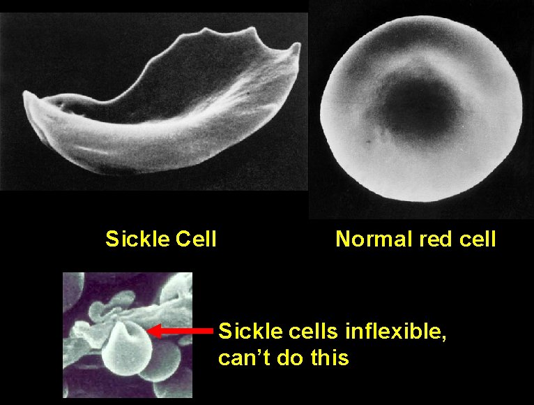 Sickle Cell Normal red cell Sickle cells inflexible, can’t do this 