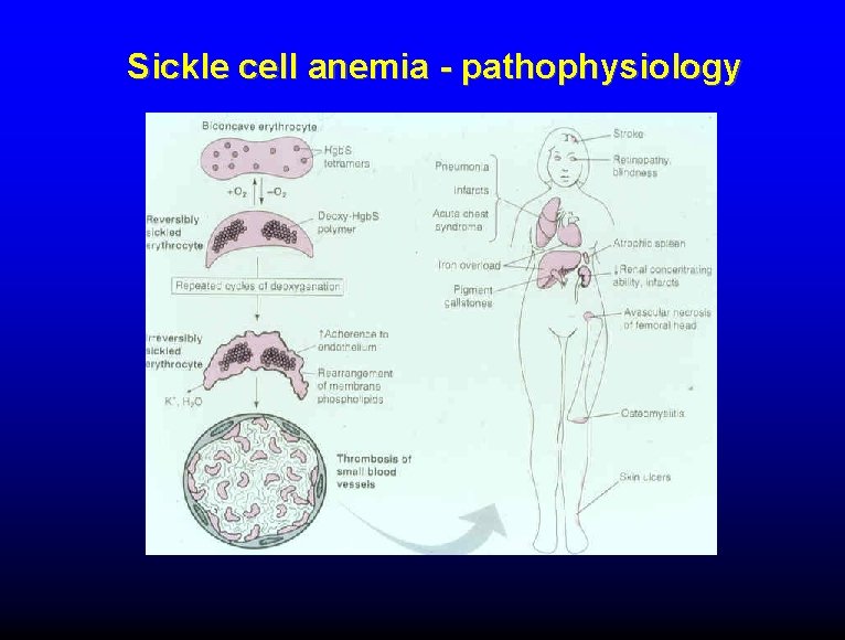 Sickle cell anemia - pathophysiology 