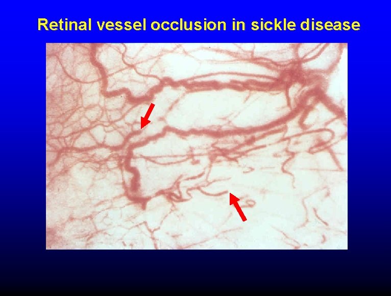 Retinal vessel occlusion in sickle disease 