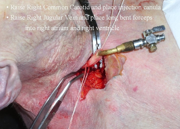  • Raise Right Common Carotid and place injection canula • Raise Right Jugular