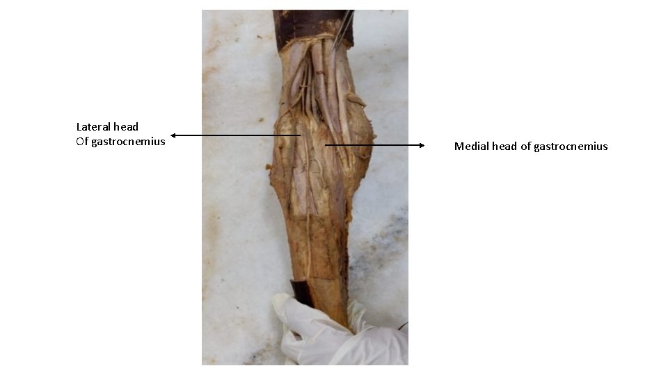 Lateral head Of gastrocnemius Medial head of gastrocnemius 