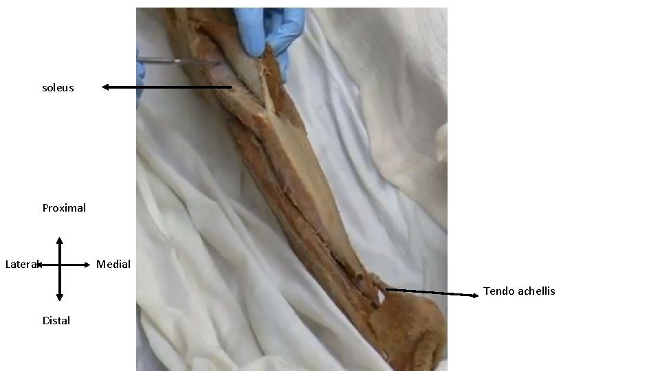 soleus Proximal Lateral Medial Tendo achellis Distal 