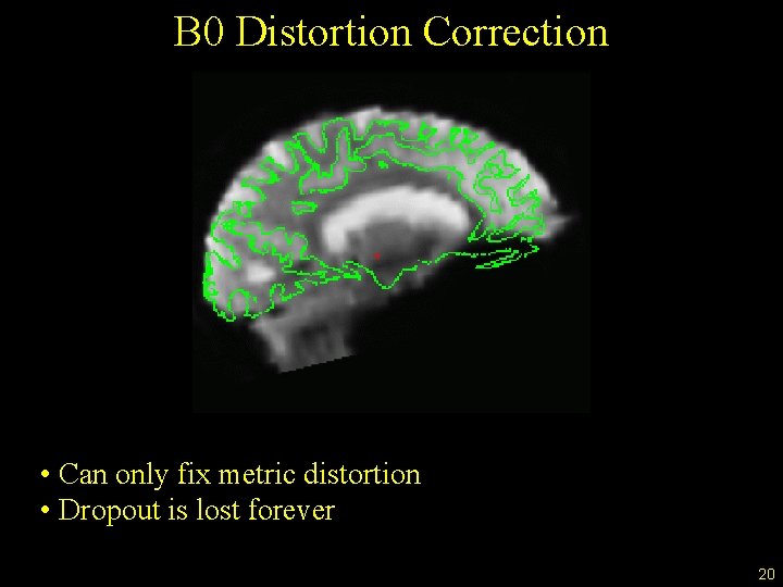 B 0 Distortion Correction • Can only fix metric distortion • Dropout is lost