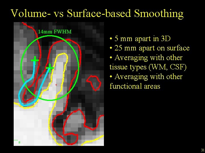 Volume- vs Surface-based Smoothing 14 mm FWHM • 5 mm apart in 3 D