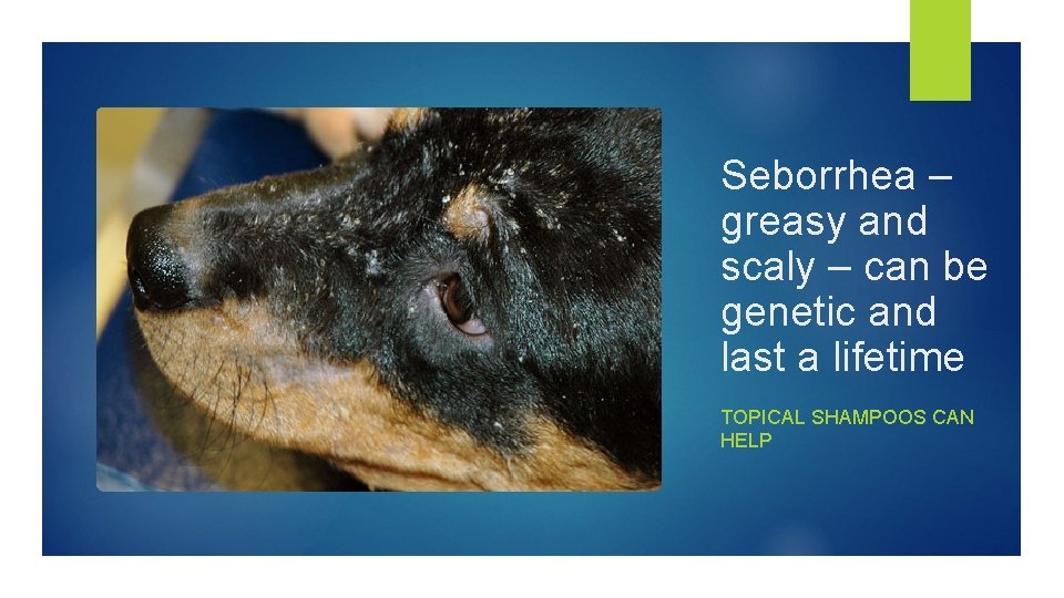 Seborrhea – greasy and scaly – can be genetic and last a lifetime TOPICAL