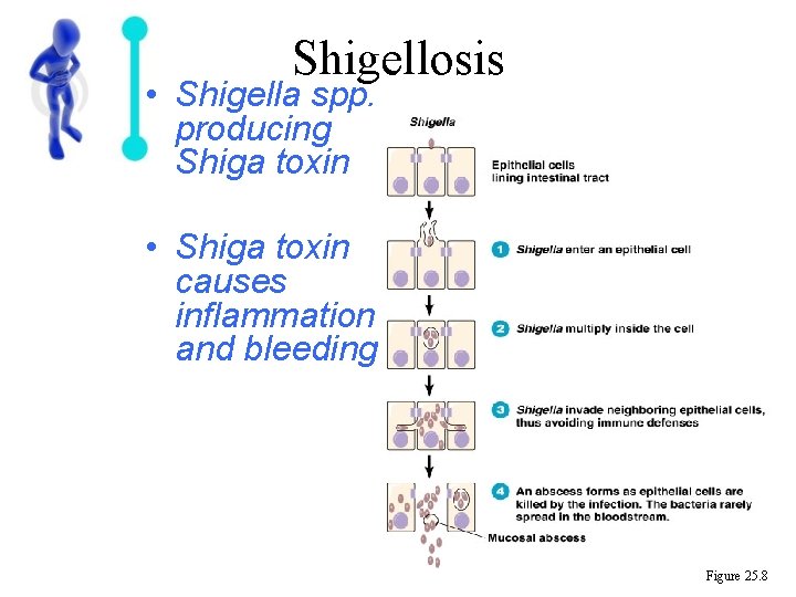 Shigellosis • Shigella spp. producing Shiga toxin • Shiga toxin causes inflammation and bleeding