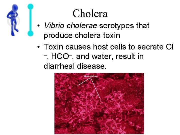 Cholera • Vibrio cholerae serotypes that produce cholera toxin • Toxin causes host cells