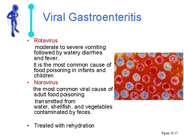 Viral Gastroenteritis • Rotavirus moderate to severe vomiting followed by watery diarrhea and fever.