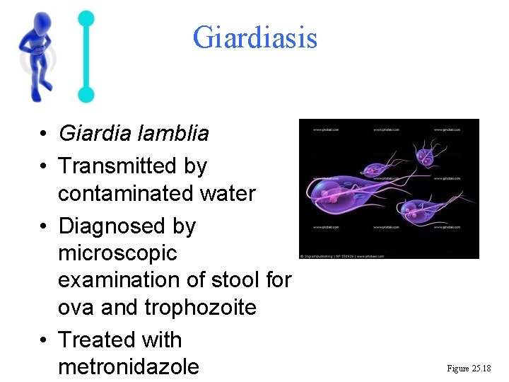 Giardiasis • Giardia lamblia • Transmitted by contaminated water • Diagnosed by microscopic examination