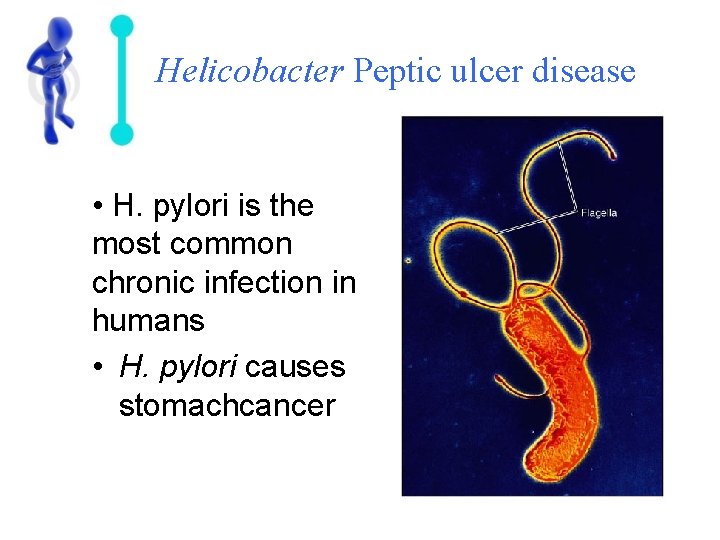 Helicobacter Peptic ulcer disease • H. pylori is the most common chronic infection in