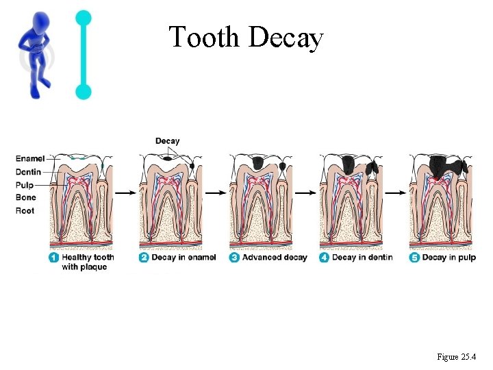 Tooth Decay Figure 25. 4 