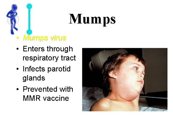 Mumps • Mumps virus • Enters through respiratory tract • Infects parotid glands •