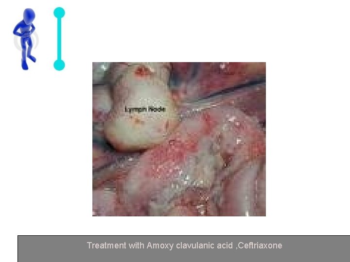Treatment with Amoxy clavulanic acid , Ceftriaxone 