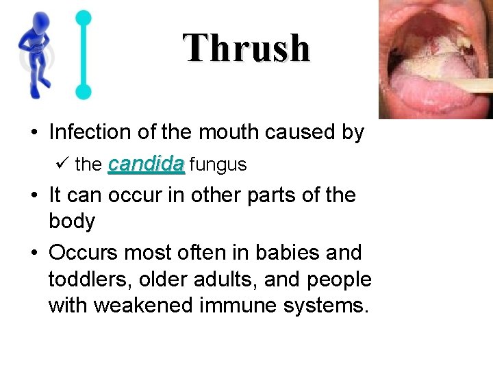 Thrush • Infection of the mouth caused by ü the candida fungus • It