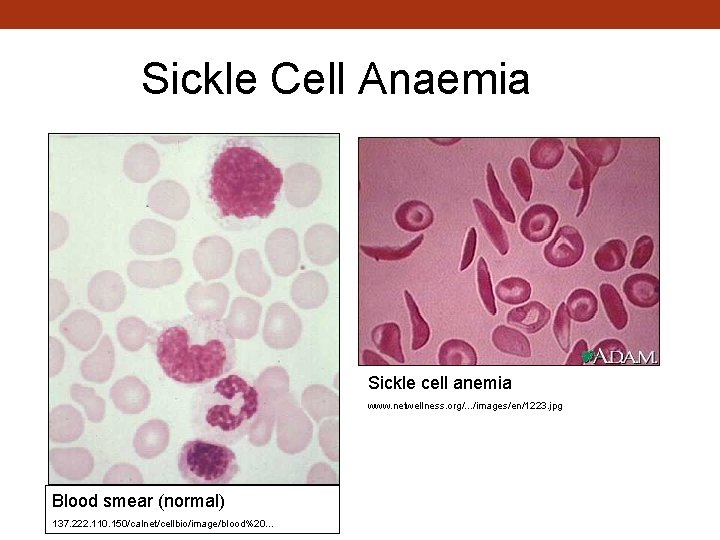 Sickle Cell Anaemia Sickle cell anemia www. netwellness. org/. . . /images/en/1223. jpg Blood