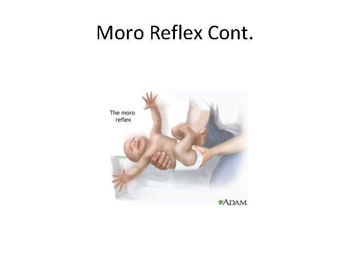 Moro Reflex Cont. 