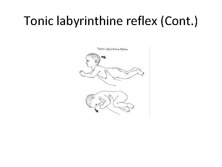 Tonic labyrinthine reflex (Cont. ) 