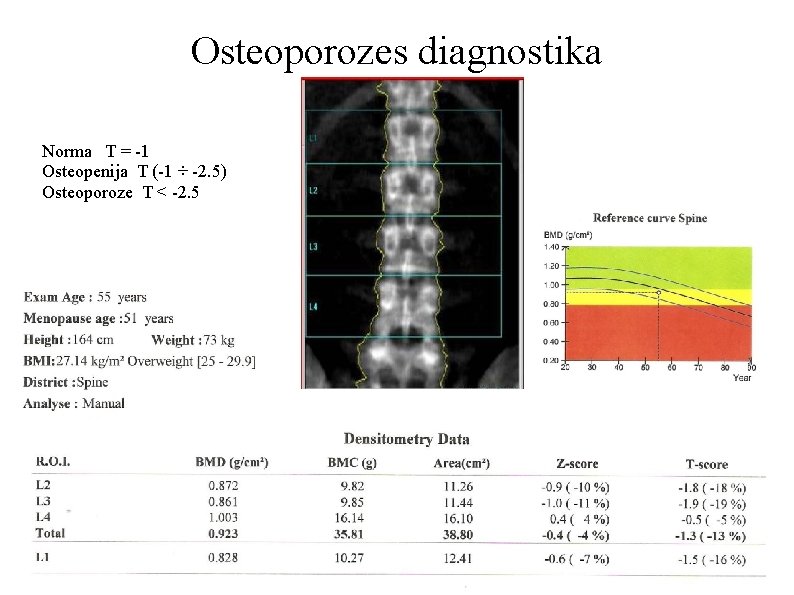 Osteoporozes diagnostika Norma T = -1 Osteopenija T (-1 ÷ -2. 5) Osteoporoze T